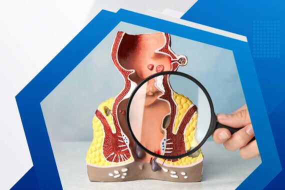 Laser hemorrhoidoplasty procedure at Toronto Hemorrhoid Clinic, offering minimally invasive treatment for internal and external hemorrhoids.