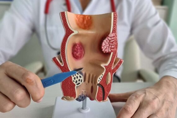 Understanding whether hemorrhoids can turn into cancer explained by Toronto Hemorrhoid Clinic