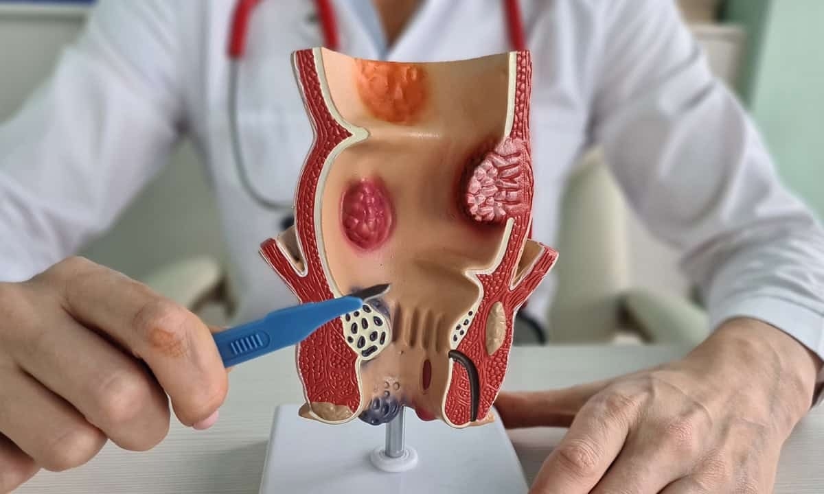 Understanding whether hemorrhoids can turn into cancer explained by Toronto Hemorrhoid Clinic