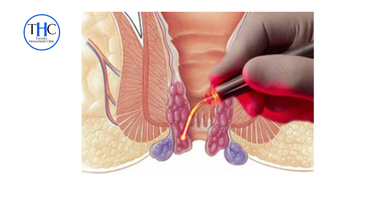 Laser Hemorrhoidoplasty Treatment Laser Hemorrhoidoplasty Laser Hemorrhoid Treatment Hemorrhoid Laser Treatment Hemorrhoid Clinic Toronto Advanced Hemorrhoid Treatment Non-Surgical Hemorrhoid Treatment